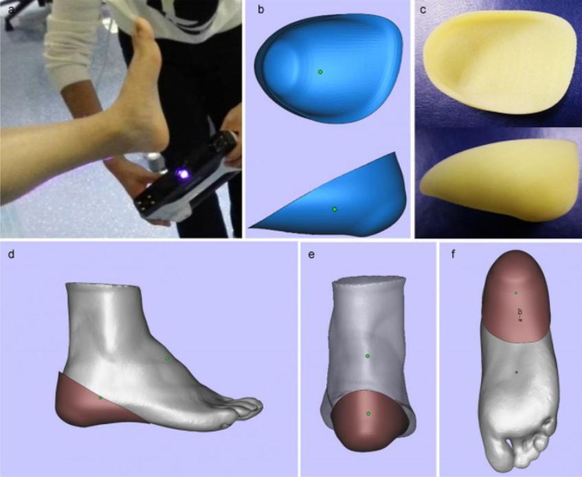 Workflow of Individualized Heel Cup 3D Printing
